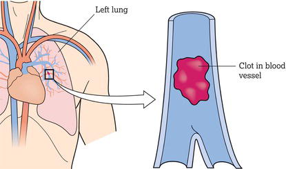 Thrombus.