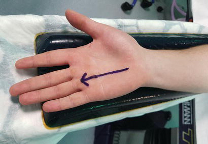 Example of skin marked for surgery.