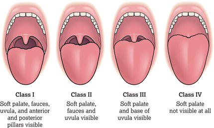 Mallampati classification of the airway.