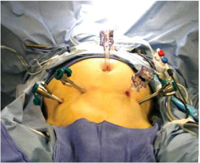 Port placement for pneumoperitoneum in laparoscopic or robotic surgery.