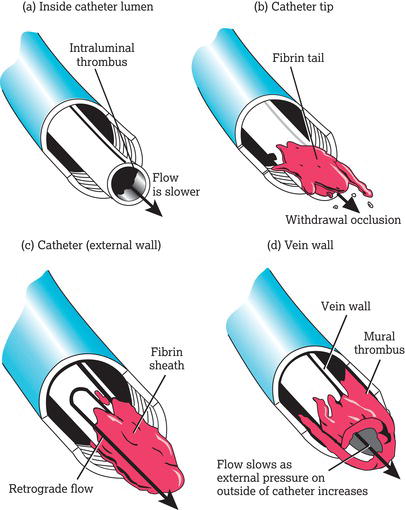 Clot formations. Source: Reproduced from Macklin and Chernecky () with permission of Elsevier.