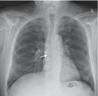 Chest X‐ray showing catheter tip correctly positioned (arrow).