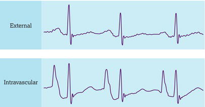 Electrocardiogram (ECG) pattern indicating raised P waves.