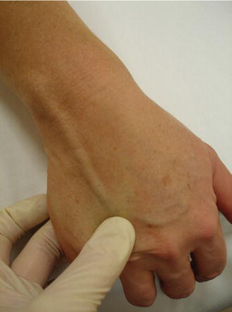 Anchoring the vein with the thumb. Source: Reproduced from Dougherty () with permission of John Wiley & Sons.