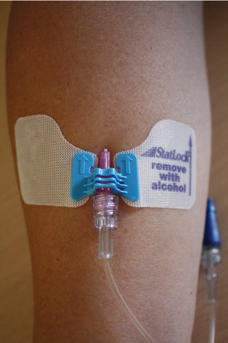 Peripheral cannula secured with StatLock.