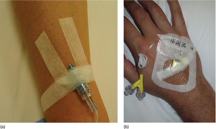 (a) Cannula in situ. (b) Cannula secured with a semi‐permeable transparent IV film dressing.