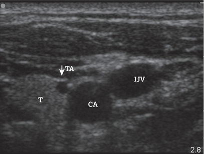 Ultrasound cross‐sectional image of the right internal jugular vein (IJV) without compression through the probe. Image orientation as seen from the he