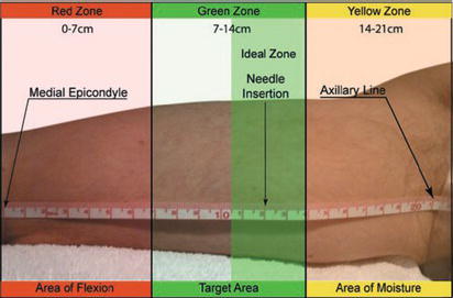 PICC Zone Insertion Method (ZIM). Source: Reproduced from Dawson () with permission of Elsevier.