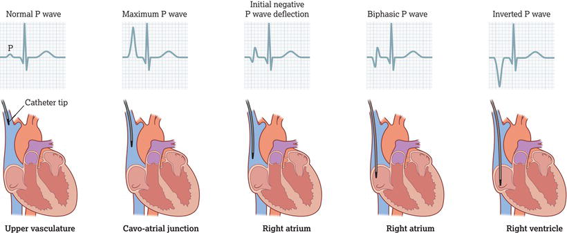 Electrocardiogram (ECG) tracing showing P wave changes depending on catheter tip position.