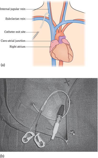 Tunnelled catheter. (a) Anatomical positioning of tunnelled catheter. (b) Patient with tunnelled catheter in situ.