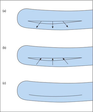 Groshong two‐way valve catheter. (a) Infusion (positive pressure). (b) Aspiration (negative pressure). (c) Closed (neutral pressure).