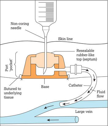 Implantable port cross‐section, accessed with non‐coring needle.