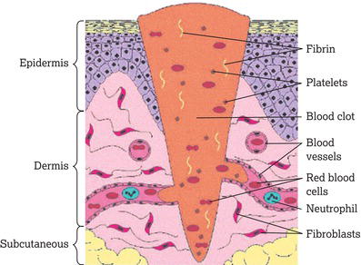 Haemostasis in a wound. 
Source: Reproduced with permission from Wayne Naylor.