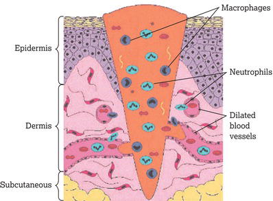 The inflammatory phase of wound healing. 
Source: Reproduced with permission from Wayne Naylor.