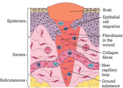 The proliferative phase of wound healing. 
Source: Reproduced with permission from Wayne Naylor.