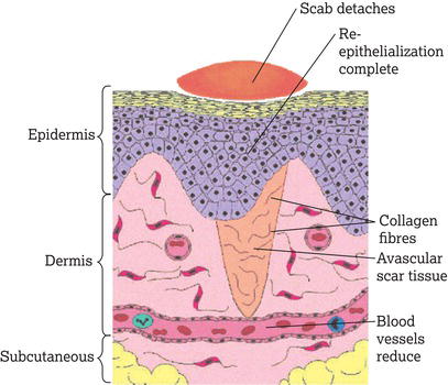 The maturation phase of wound healing. 
Source: Reproduced with permission from Wayne Naylor.