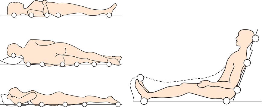 Common locations of pressure ulcers. 
Source: Reproduced with permission of The Royal Marsden NHS Foundation Trust.