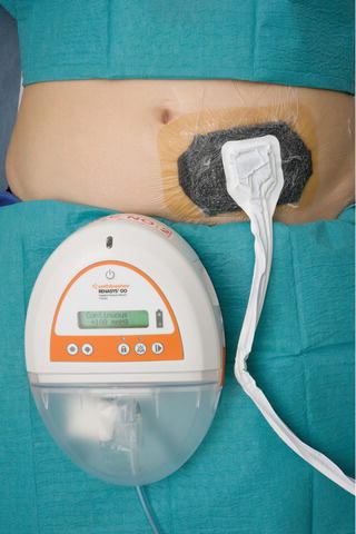 Negative pressure wound therapy dressing and unit (example of standard equipment and application).