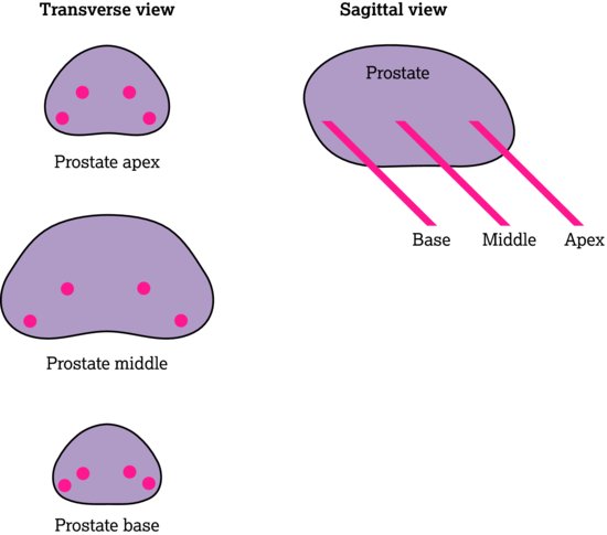 Prostate core biopsy.