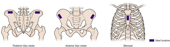 Common sites for bone marrow examination, arranged in order of preference. Normally, only aspirations and not biopsies are done on the sternum because