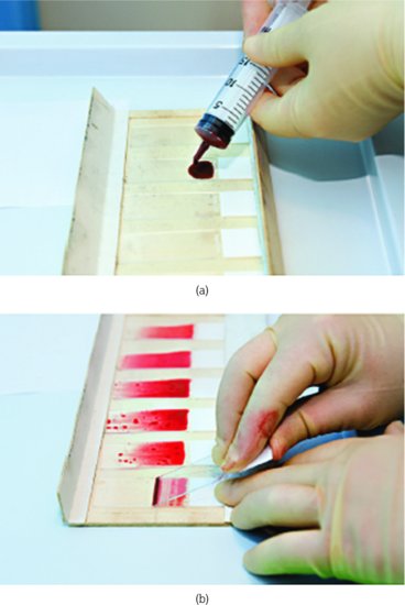 (a) Preparation of aspiration smears. (b) Completed aspiration smear. Source: Dougherty and Lister ().