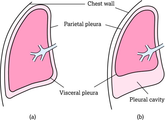 Lung anatomy. (a) Normal lung anatomy showing pleura. (b) Lung demonstrating presence of pleural effusion. Source: Dougherty and Lister ().