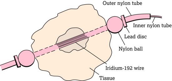 Iridium‐192 wire in polythene cannula. Typical assembly in tissue. Source: Dougherty and Lister ().