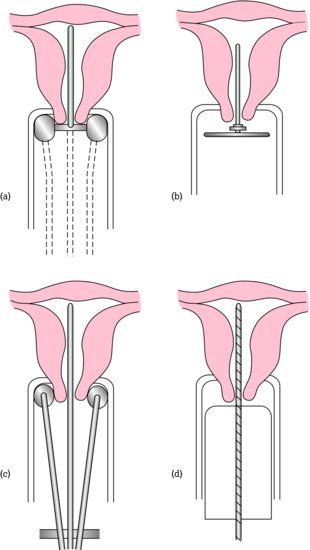 Gynaecological caesium applicators. Arrangement of brachytherapy sources in the uterus and vagina for treatment of cervical carcinoma. Sources may be 