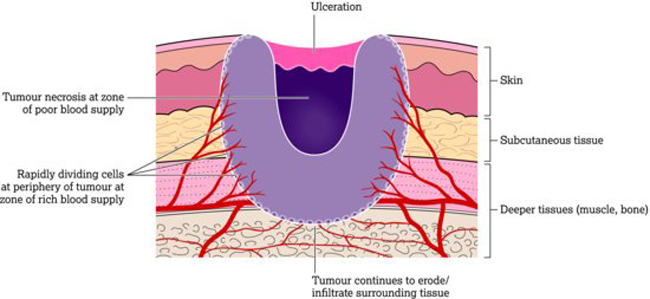 Diagram representing vessels and skin in a malignant fungating wound.