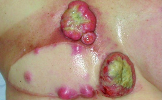 Fungating malignant wound from recurrent breast cancer – chest wall resurfaced with flap reconstruction. Recurrent nodules arising around and infiltra