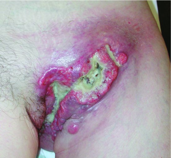 Deep ulcerating fungating malignant wound caused by untreated squamous cell carcinoma of the vulva. Source: Naylor (). Reproduced with permission.