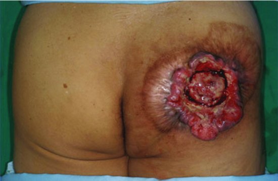 Marjolin's ulcer on a buttock arising in an area of previous skin graft or burn scar. Source: Choi et al. (). Reproduced with permission of The Korean