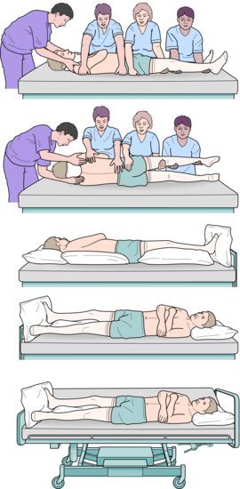 Log rolling and positioning of patient with spinal cord compression or injury. Note: In practice five people are needed for this manoeuvre. Source: Ad