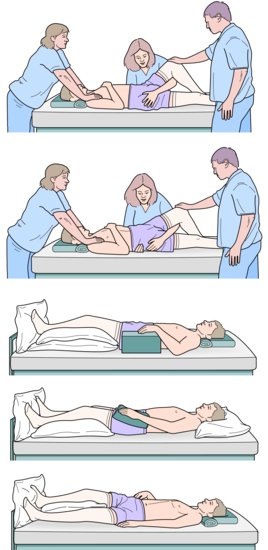 Pelvic twist for patient with unstable cervical spine. Note: In practice five people are needed for this manoeuvre. Source: Adapted from SIA (2000). I