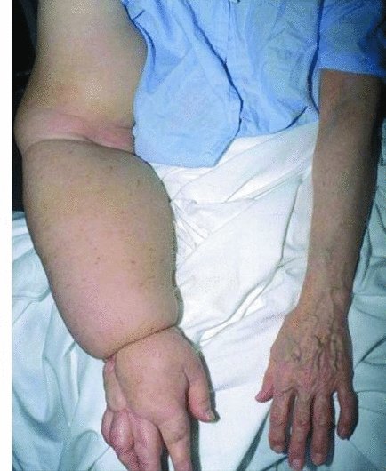 Severe uncomplicated lymphoedema of the arm. Source: Dougherty and Lister ().