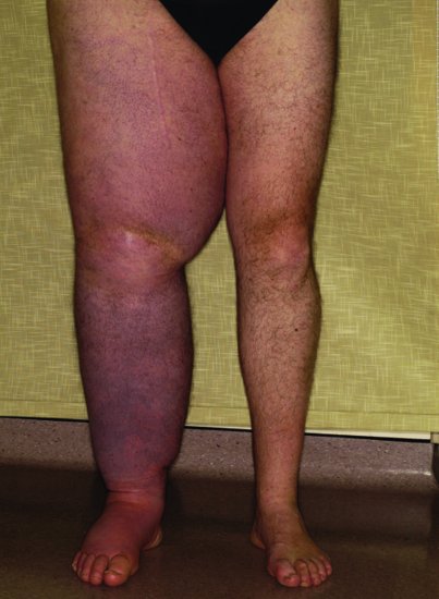 Example of a misshapen limb after bandaging. Source: Dougherty and Lister ().