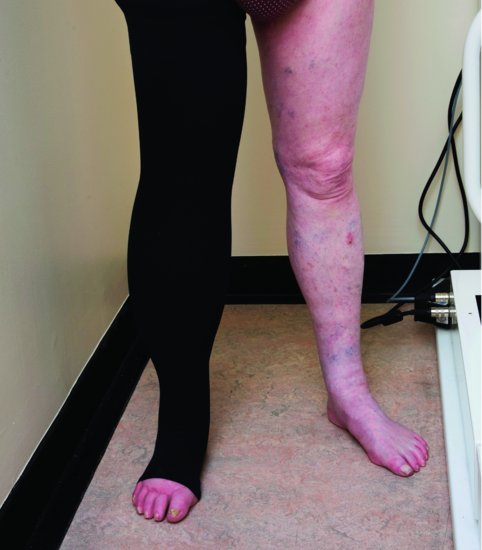 Example of elastic compression garment for the leg.