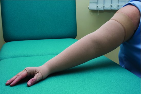 Example of elastic compression garment for the arm.