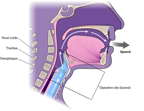 Operative site for surgical voice restoration. Source: Dougherty and Lister (). Image courtesy of InHealth Technologies.