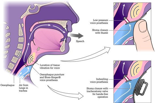 Voice prosthesis in situ. Source: Dougherty and Lister (). Image courtesy of InHealth Technologies.